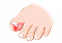 Cum sa vindeci o unghie incarnata?