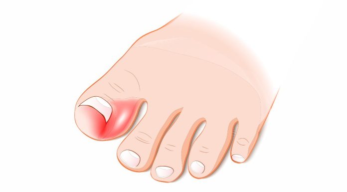 Cum sa vindeci o unghie incarnata?