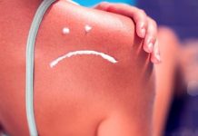 Greseli care ar trebui evitate atunci cand te confrunti cu o arsuri solare