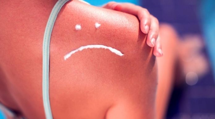 Greseli care ar trebui evitate atunci cand te confrunti cu o arsuri solare